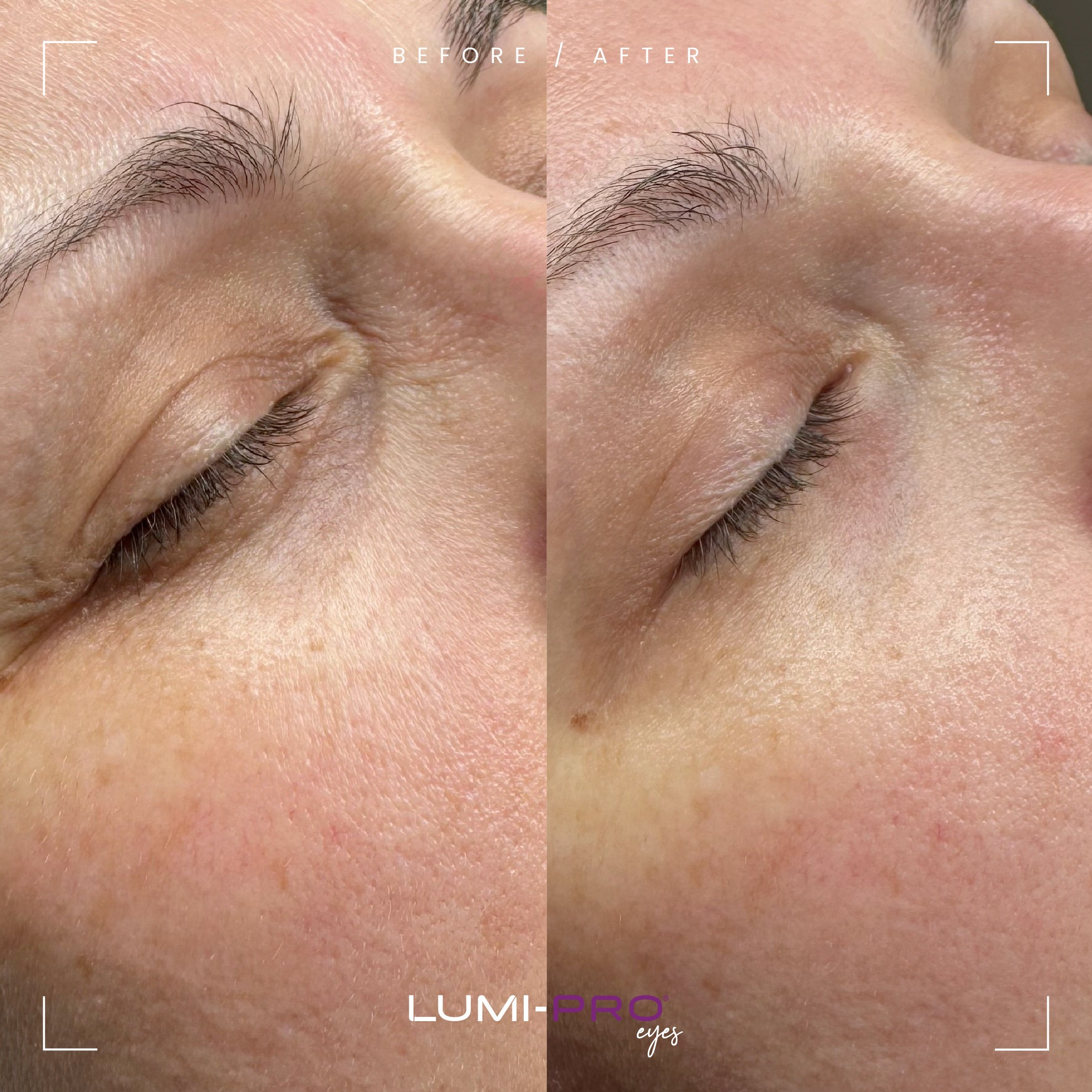 LUMI-PRO Eyes - Image 3
