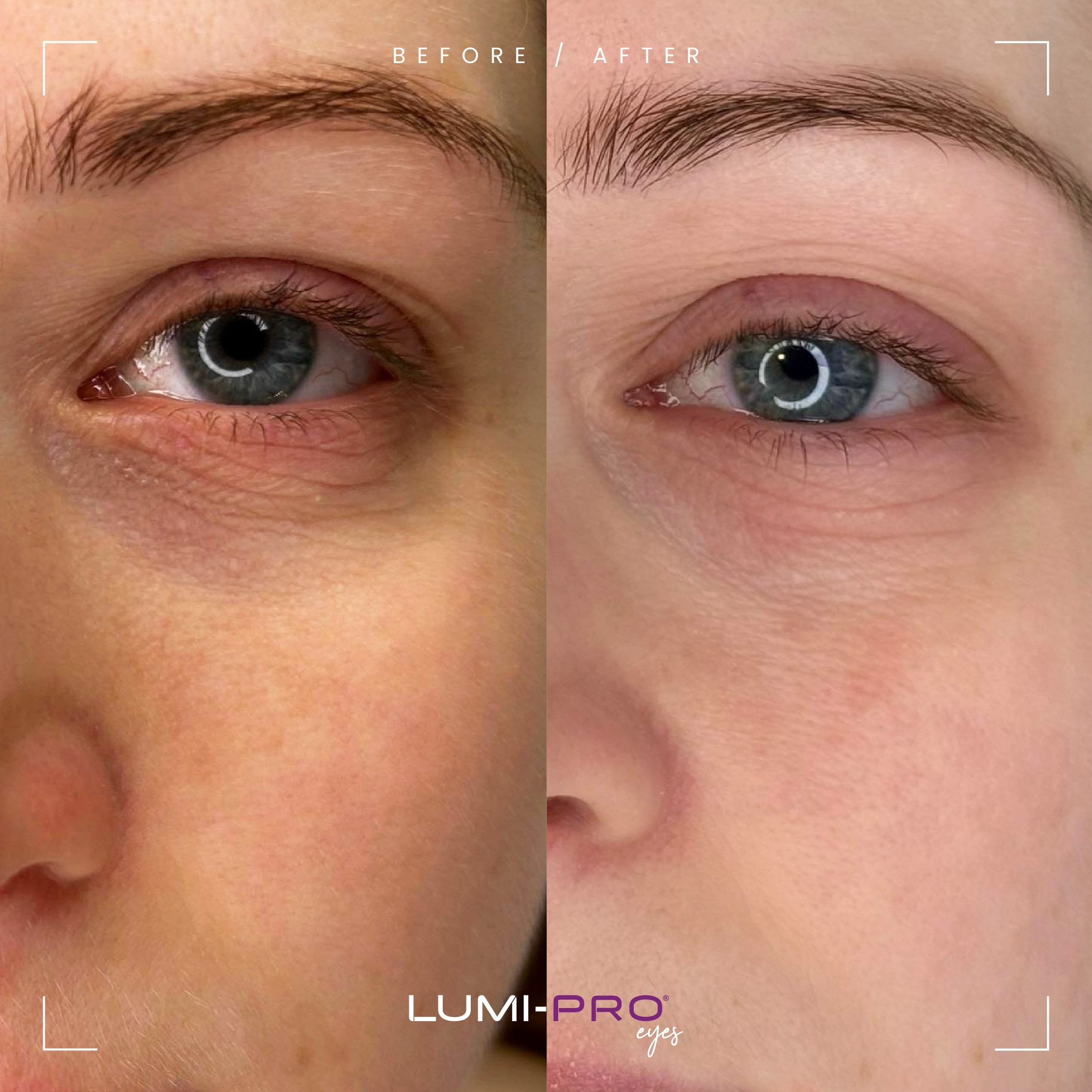 LUMI-PRO Eyes - Image 4